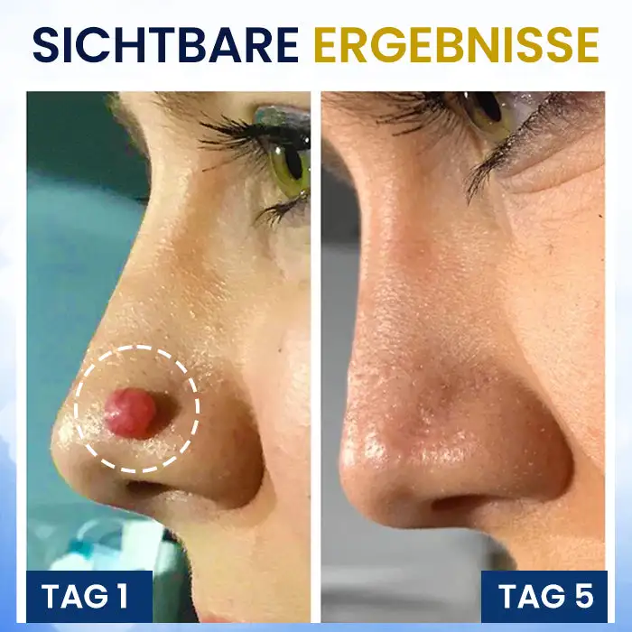 Hautanhängsel-Kryo-Behandlungsspray - Image 3
