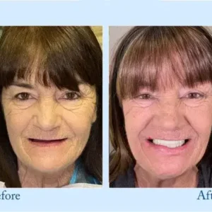🦷Advanced Customized Full Denture Set🦷 (⏰Limited time discount last 30 minutes⏰)💎 - Image 6