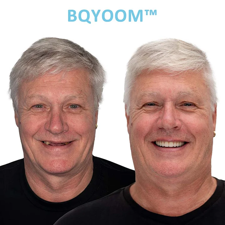 Dentures | Invisible Comfort, Natural Grip 🌟