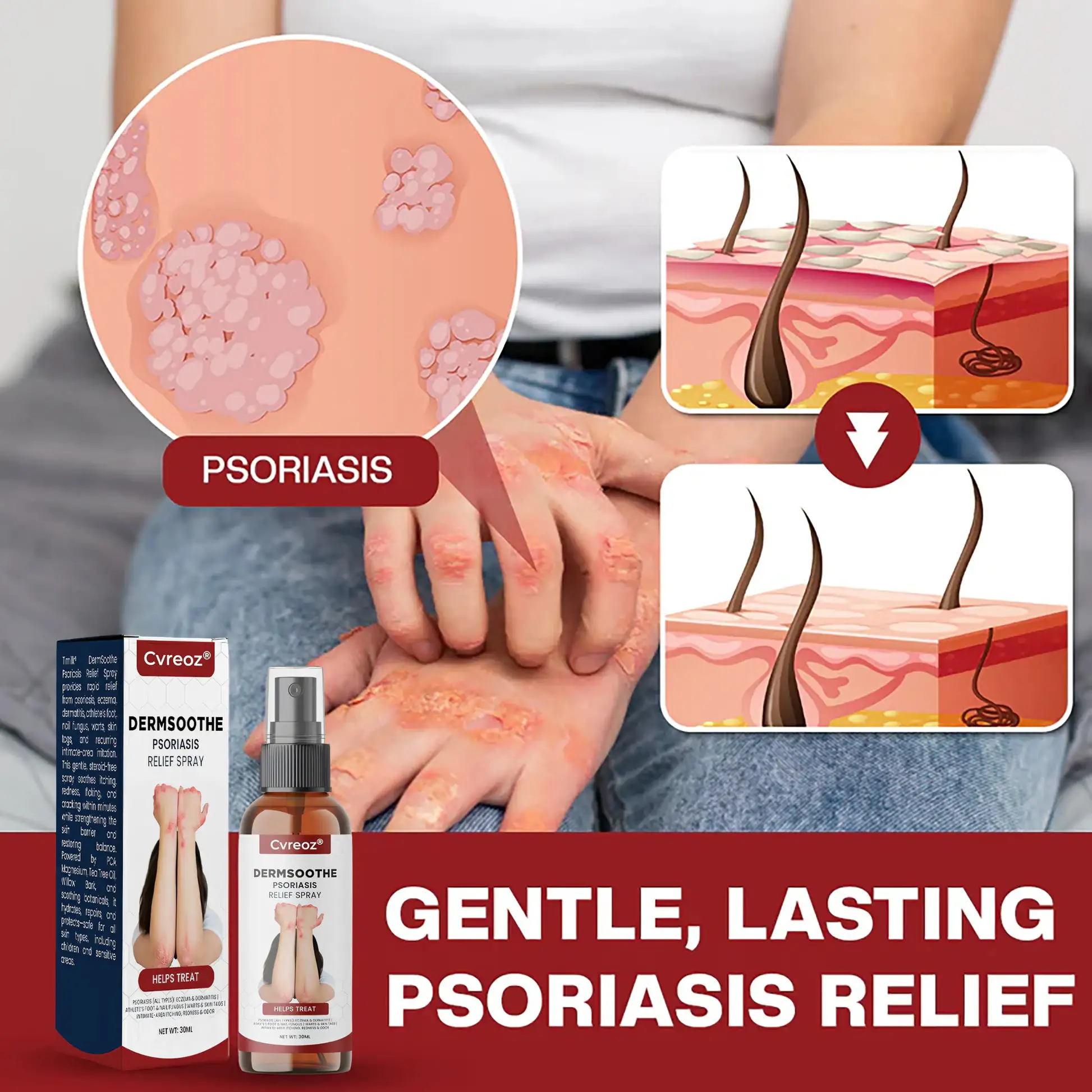 DermSoothe Psoriasis Relief Spray - Image 3