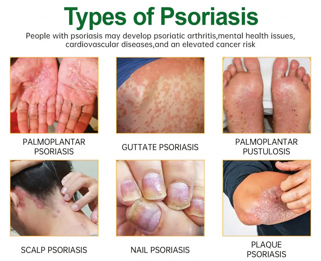 Knotaway Psoriasis Cream - Image 3