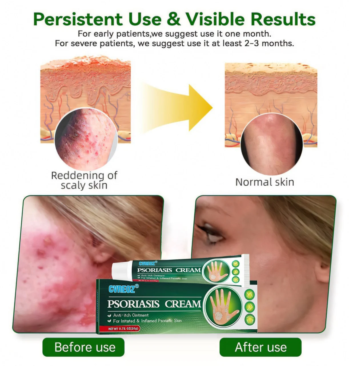 Knotaway Psoriasis Cream - Image 6