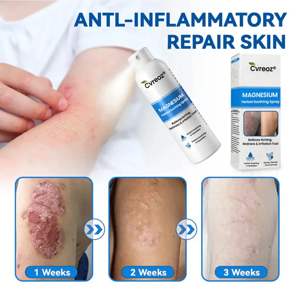 Magnesium Herbal Psoriasis Spray - Image 3