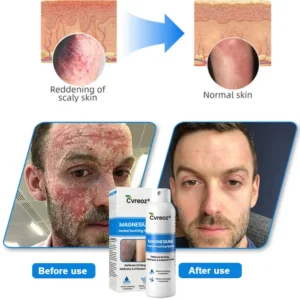 Magnesium Herbal Psoriasis Spray - Image 7