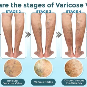 VenaRestore MicroNeedle Vein Repair Patch - Image 7
