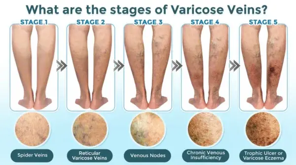 VenaRestore MicroNeedle Vein Repair Patch - Image 5
