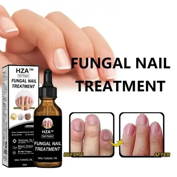 Fungal Nail Treatment - Image 2