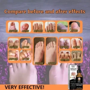 Fungal Nail Treatment - Image 6