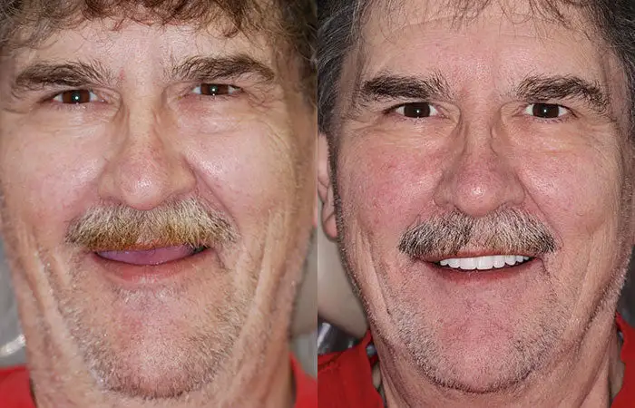--🦷Advanced Customized Full Denture Set🦷 {Developed by Harvard University} - Image 10