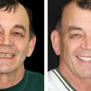 --🦷Advanced Customized Full Denture Set🦷 {Developed by Harvard University} - Image 11