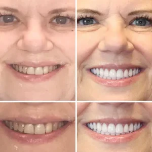 --🦷Advanced Customized Full Denture Set🦷 {Developed by Harvard University} - Image 7