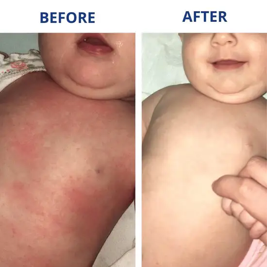 Eczema & Psoriasis Cream - Image 4