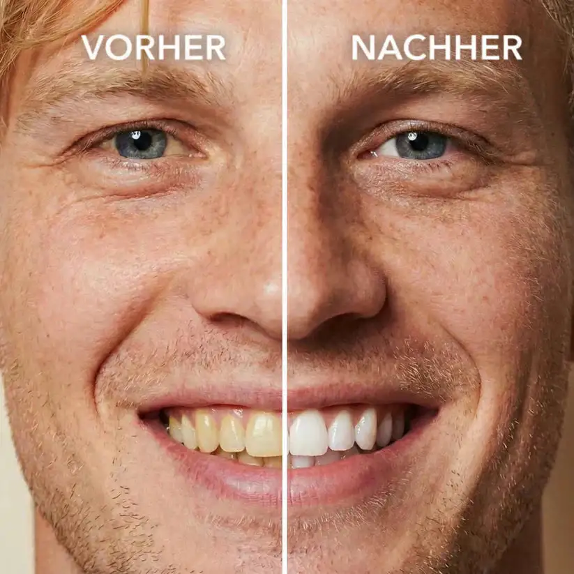 Teeth whitening - Instant Whitening for a Sparkling Smile - Image 4