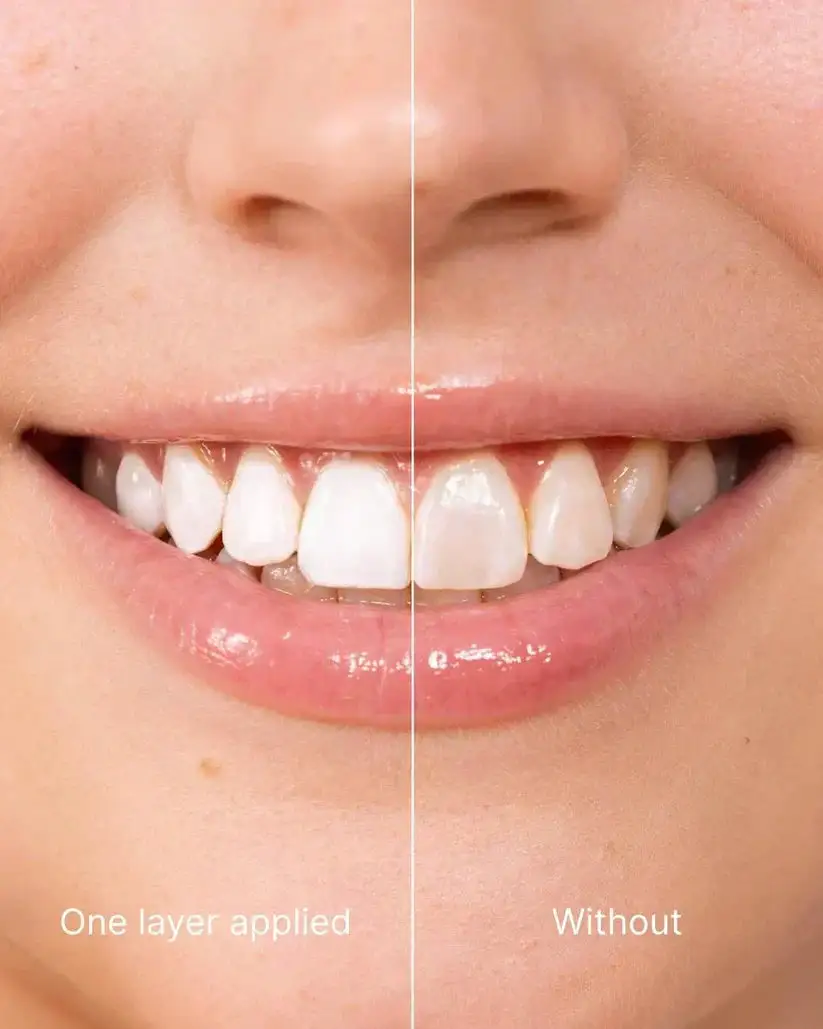 Teeth whitening - Instant Whitening for a Sparkling Smile - Image 5