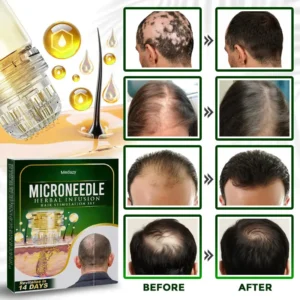 Microneedle Herbal Infusion Hair Stimulation Set - Image 4
