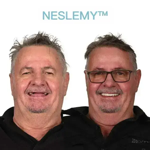 GelFit Dentures - Image 5
