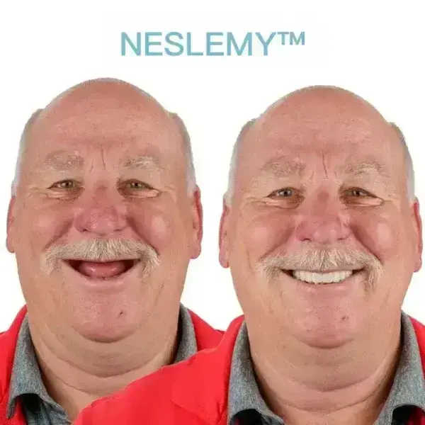 GelFit Dentures - Image 6