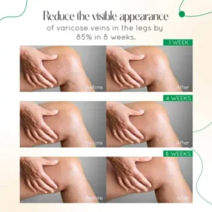 Vein Therapy Cream - Image 11