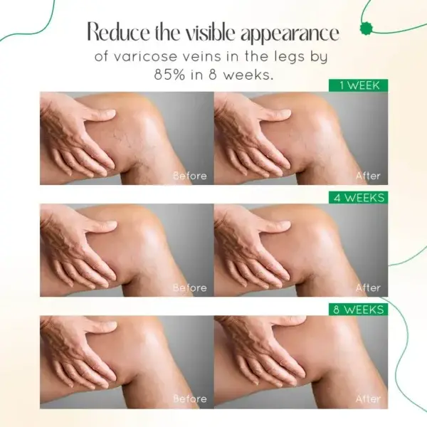 Vein Therapy Cream - Image 11