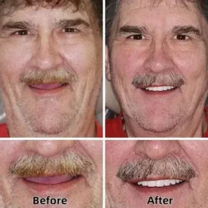 【Official Brand -Custom-Fit Functional Dentures — Combination pack - Image 4