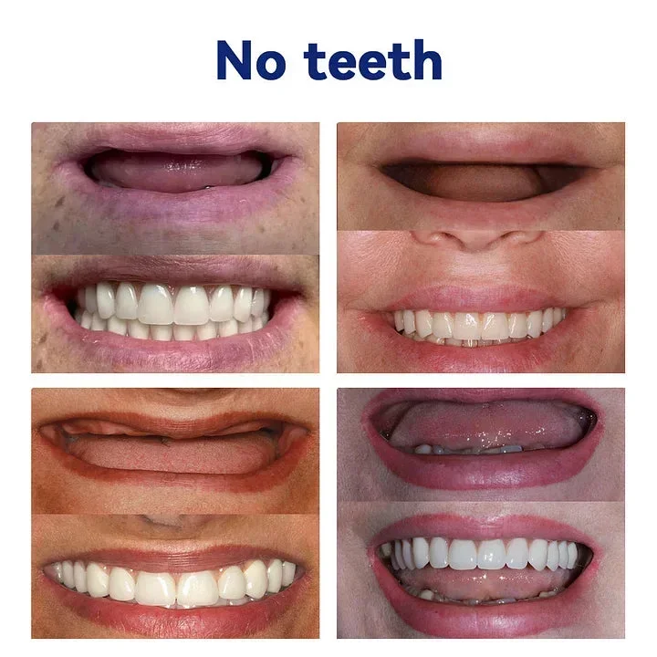 -🦷Advanced Customized Full Denture Set🦷 (⏰Limited time discount last 30 minutes⏰) - Image 8