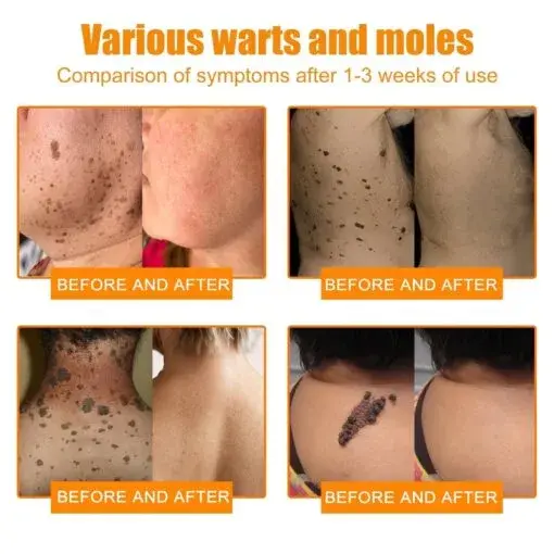 Bee Venom Wart & Tag Removal Cream - Image 7
