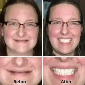–Advanced Custom-Fit Functional Dentures - Image 4