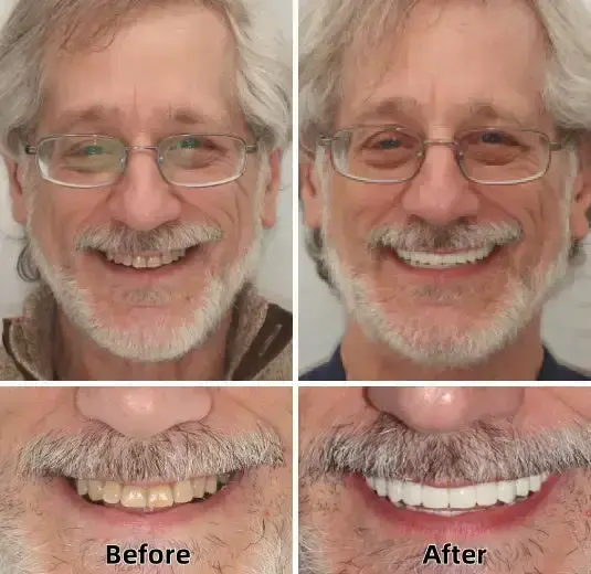 –Advanced Custom-Fit Functional Dentures - Image 5