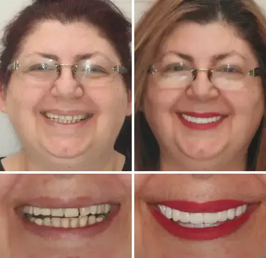 Premium Dentures - Image 7