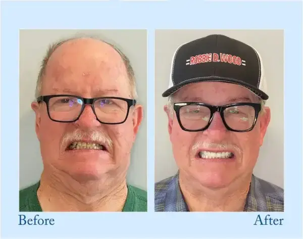 Dentures - Image 10