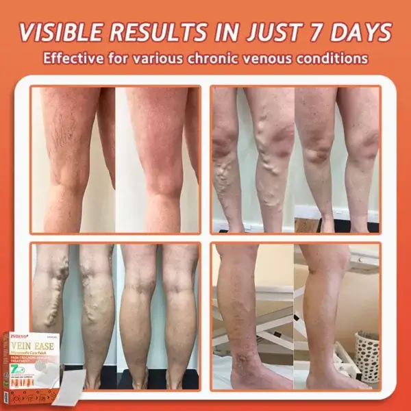 Vein Ease Microneedle Care Patch(For Spider Veins, Varicose Veins, Swelling & Leg Fatigue) - Image 6
