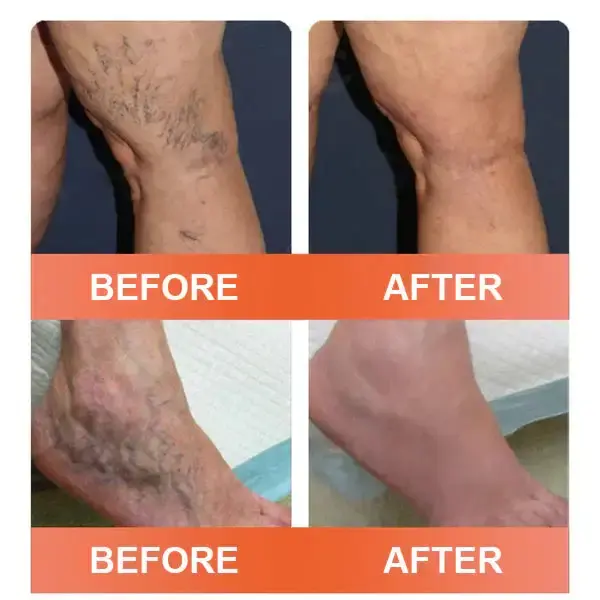 Vein Ease Microneedle Care Patch(For Spider Veins, Varicose Veins, Swelling & Leg Fatigue) - Image 8