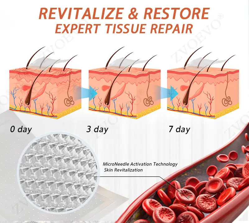 Vein Ease Microneedle Care Patch(For Spider Veins, Varicose Veins, Swelling & Leg Fatigue) - Image 10