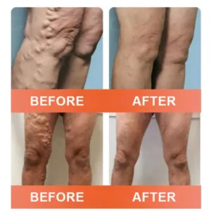 Vein Ease Microneedle Care Patch(For Spider Veins, Varicose Veins, Swelling & Leg Fatigue) - Image 5