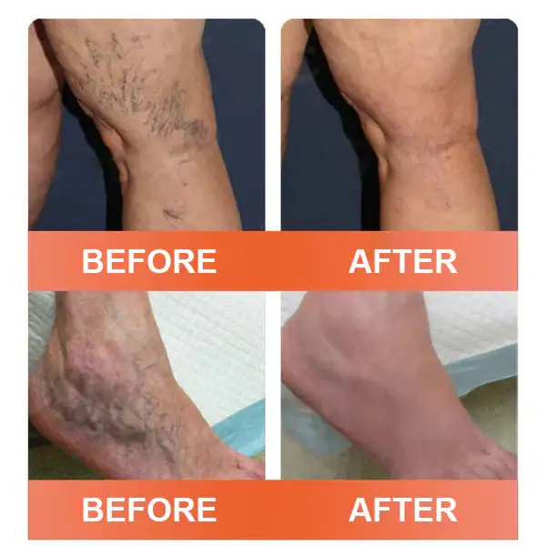 Vein Ease Microneedle Care Patch(For Spider Veins, Varicose Veins, Swelling & Leg Fatigue) - Image 6