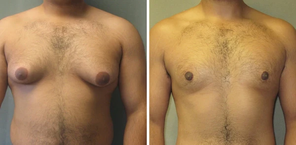 Gynecomastia Cream – Chest Fat Burner - Image 5