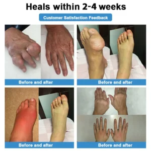 ✅ official Nano👩‍⚕️(COA) Recommended microneedle joint patch (painless, long-lasting, suitable for arthritis varicose veins and various orthopedic disease） - Image 10