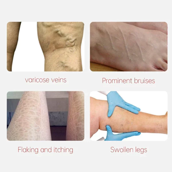 Varicose Veins Relief Cream - Image 3