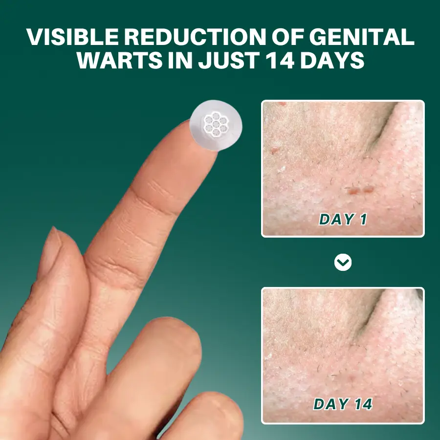 Magnesium MicroPin HPV Genital Wart Removal Patch - Image 4
