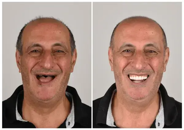 🦷 Custom-Fit Functional Dentures 😁 Smile with Confidence - Image 2