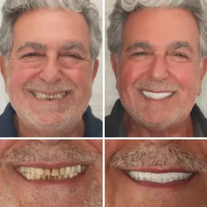 {Developed by Harvard University}🦷Advanced Customized Full Denture Set🦷 - Image 7