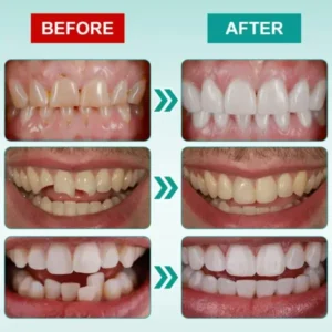 Instant Stick-on Dental Veneers (✅Clinically proven, easy-to-use dental veneers trusted by over 8,000 US users for a comfortable, natural smile.) - Image 8
