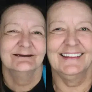 Alternative view of 【Official Brand -Custom-Fit Functional Dentures — Combination pack
