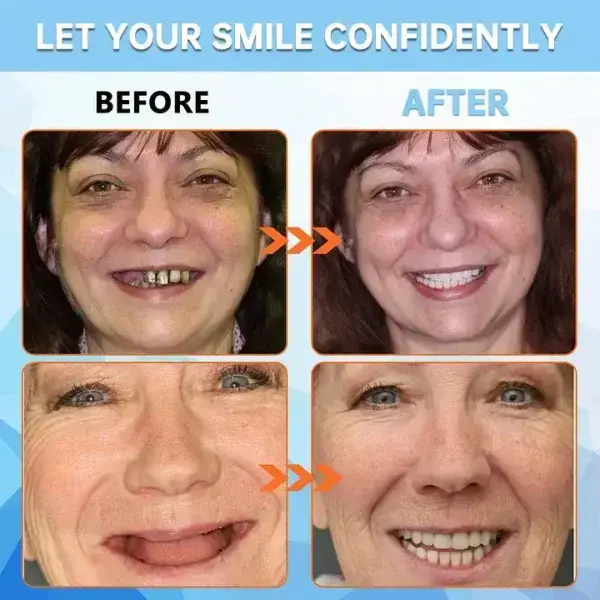 AI Bionic Adsorption Dentures - Image 8
