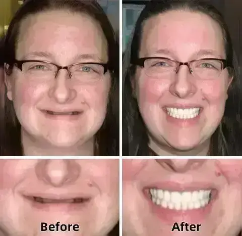 –Advanced Custom-Fit Functional Dentures - Image 4