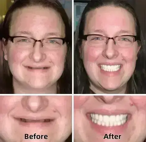 –Advanced Custom-Fit Functional Dentures - Image 4