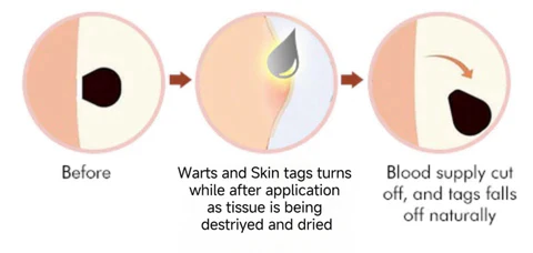 Bee Venom Wart & Tag Removal Cream - Image 10