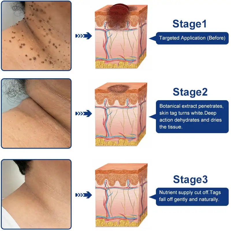 Targeted Skin Tag & Wart Removal Cream – Time-Released Phyto-Exfoliant (12% Celandine ) & Bio-Active Terpene Viral-Inhibitor (8% Thuja) - Image 6