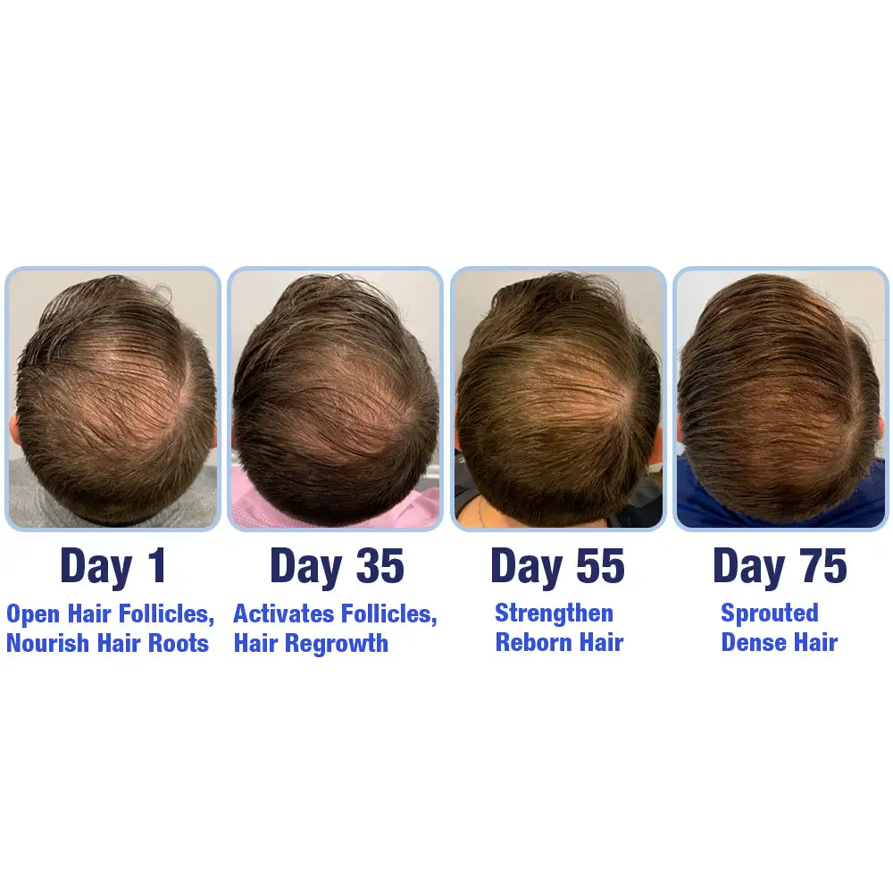 PotentGRO Hair Treatment Roller - Image 3