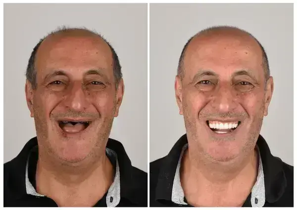 🦷 Custom-Fit Functional Dentures 😁 Smile with Confidence - Image 2